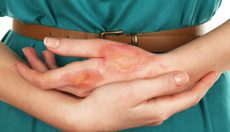 Most severe burn injuries are caused by other people