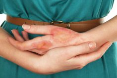 Most severe burn injuries are caused by other people