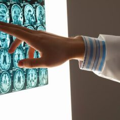 Traumatic brain injury in Longview Texas